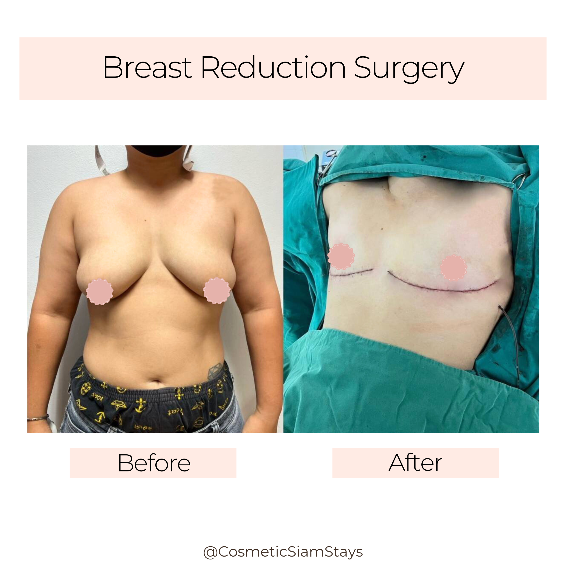 Breast Reduction Surgery