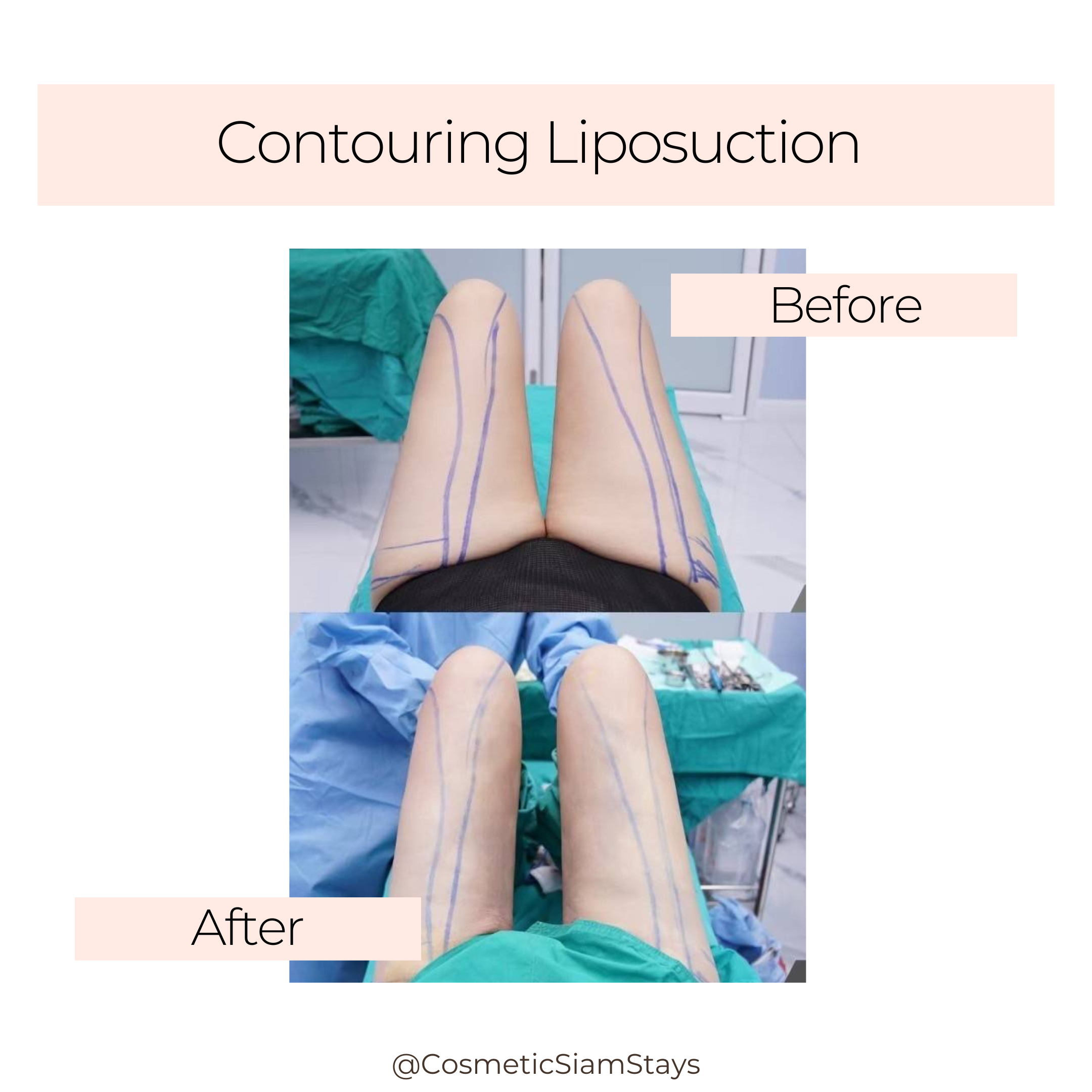 Contouring Liposuction