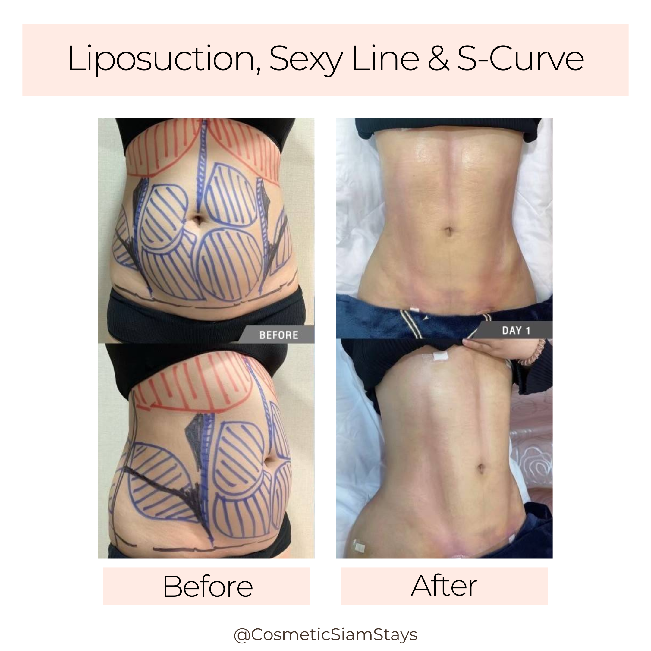 Liposuction, Sexy Line and S-Curve