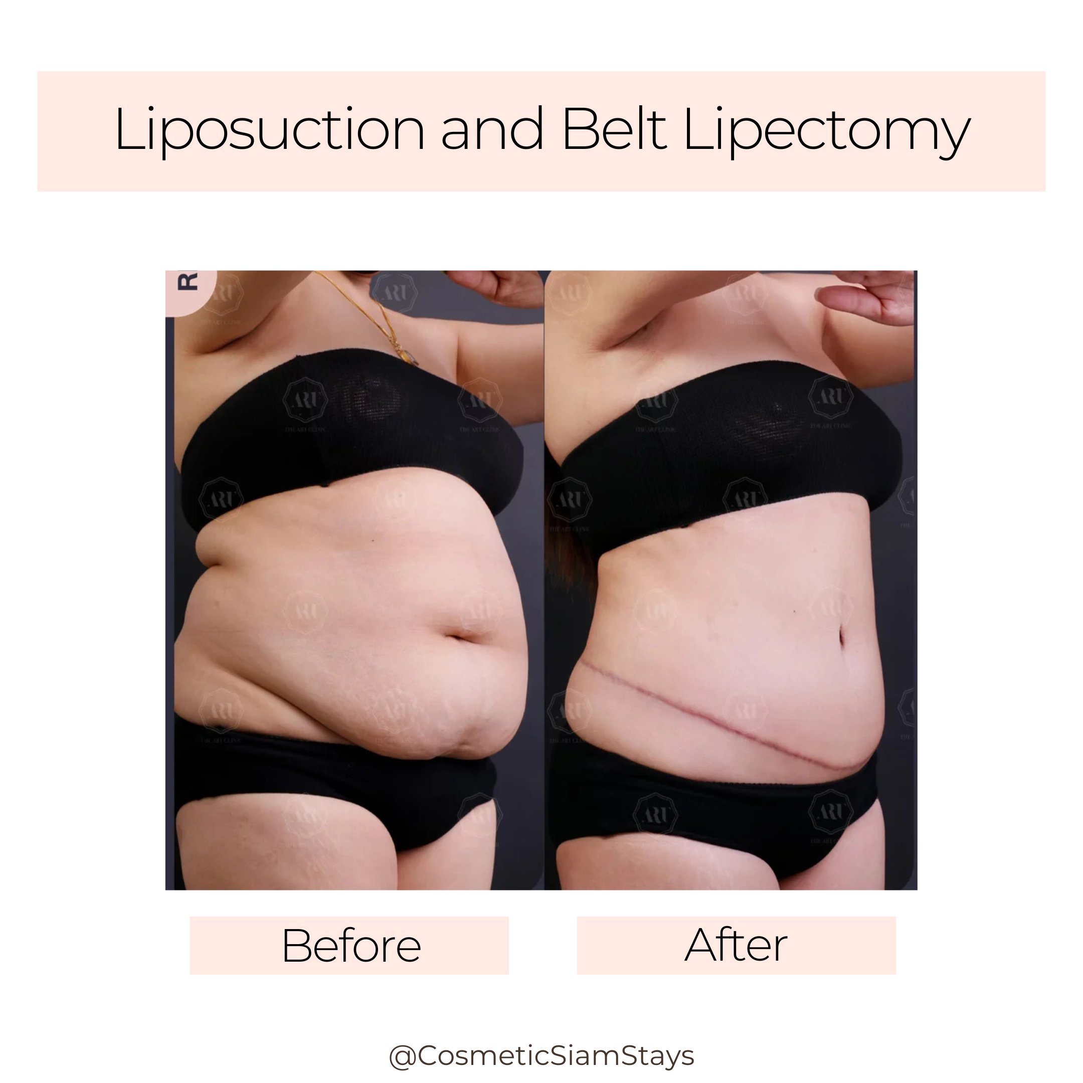 Tummy Tuck 2