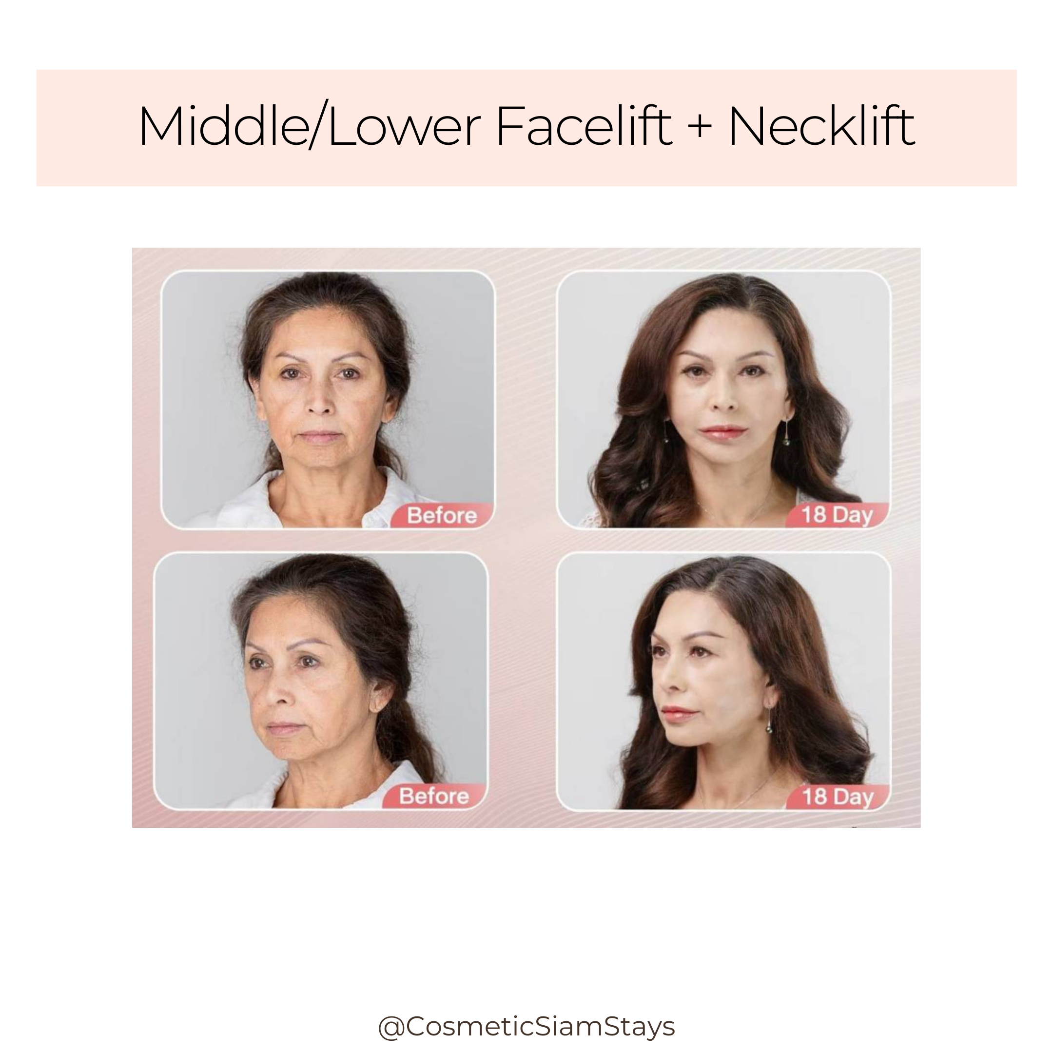 Facelift and Necklift