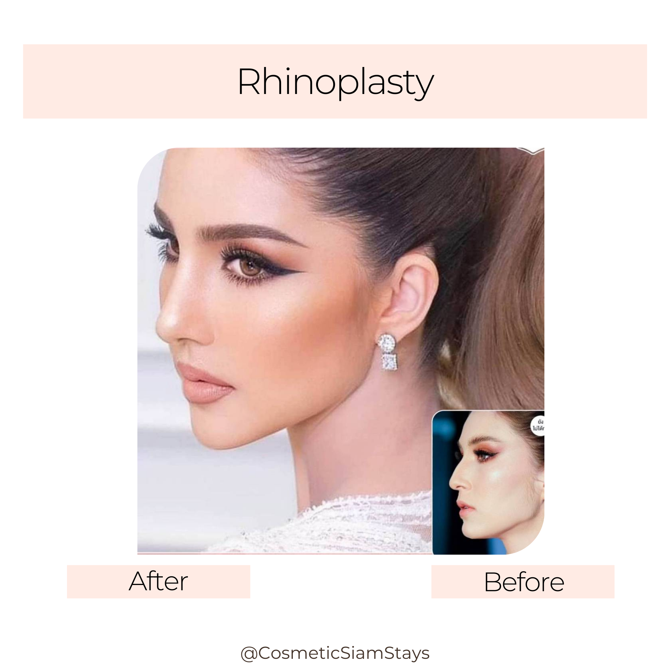 Rhinoplasty