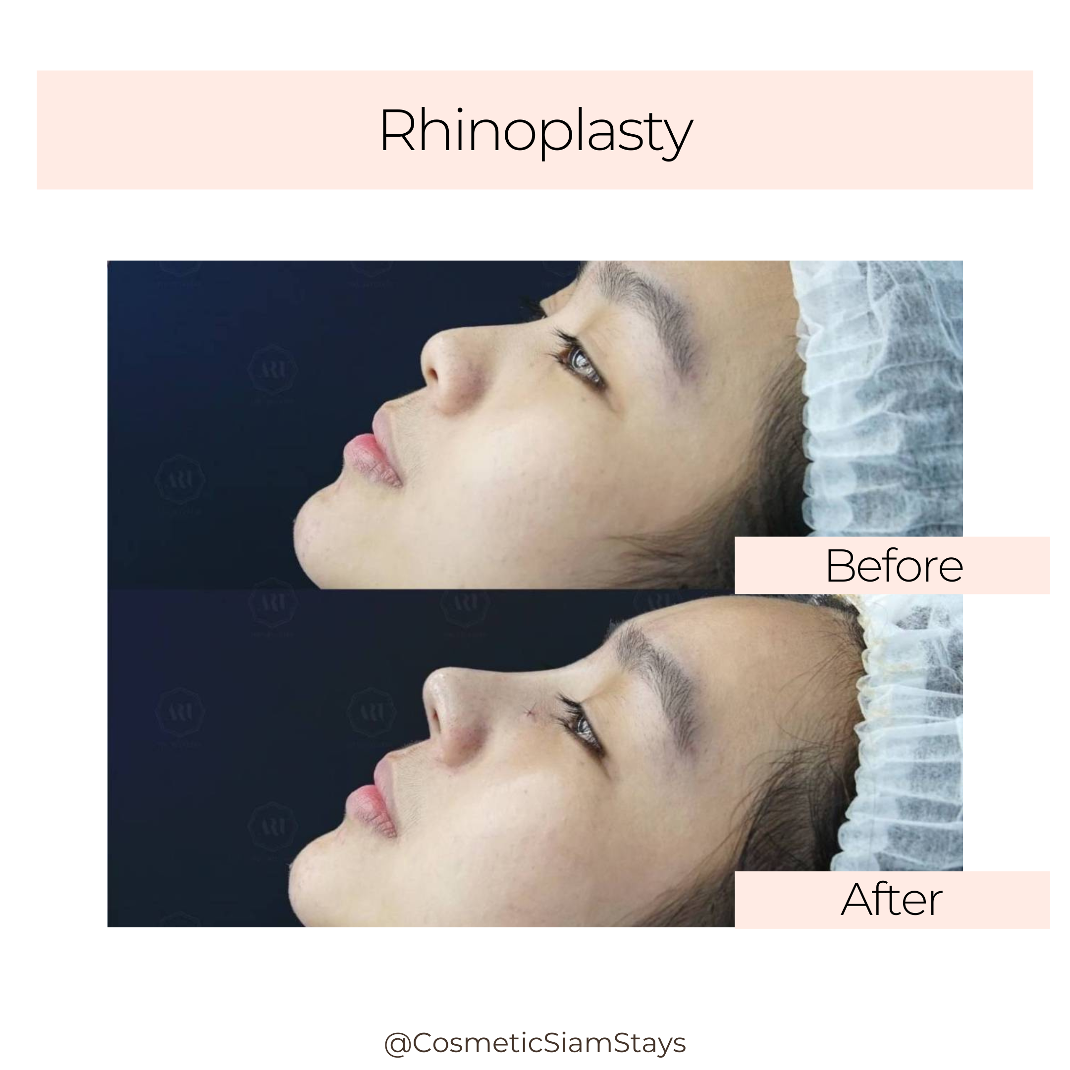 Rhinoplasty