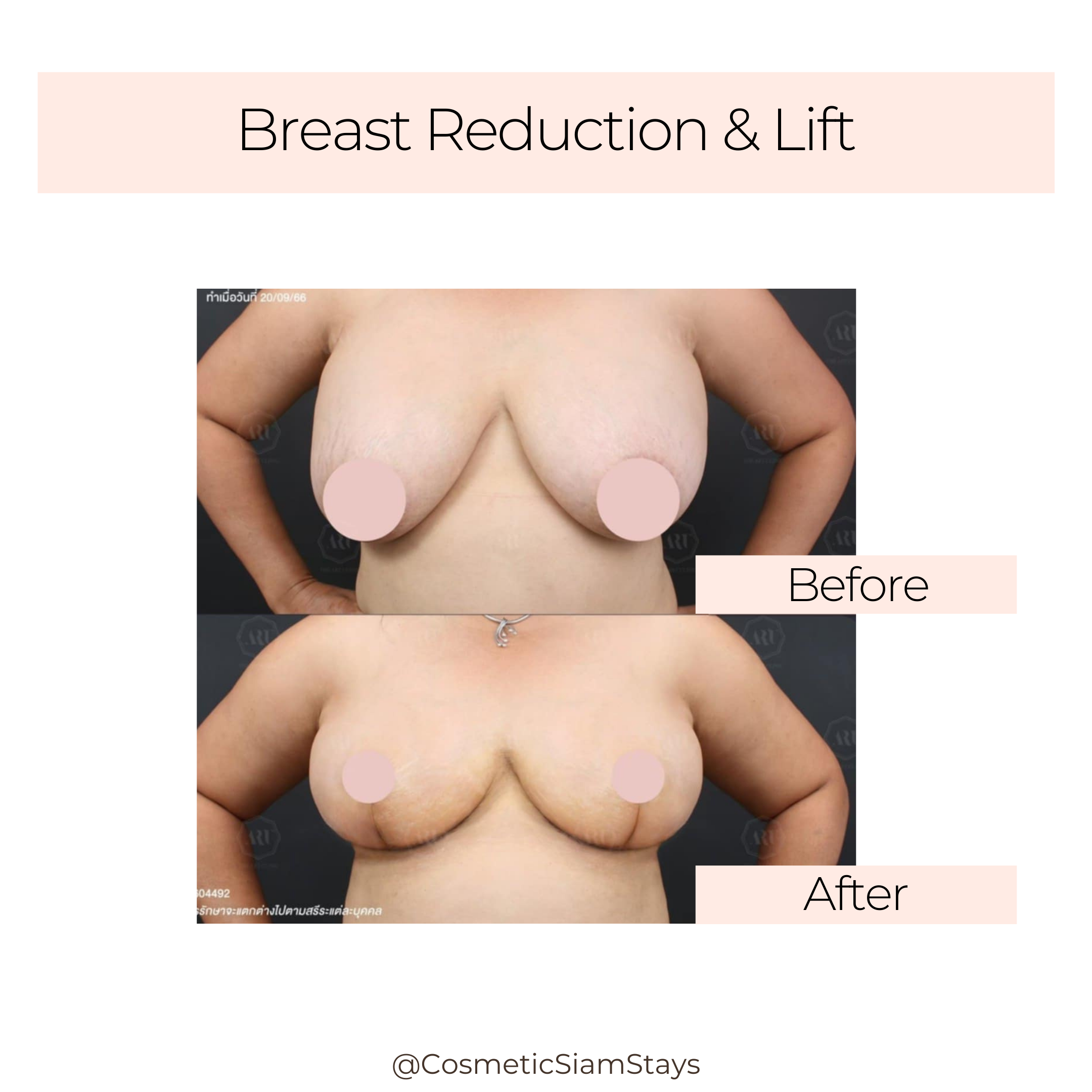 Breast Lift 9
