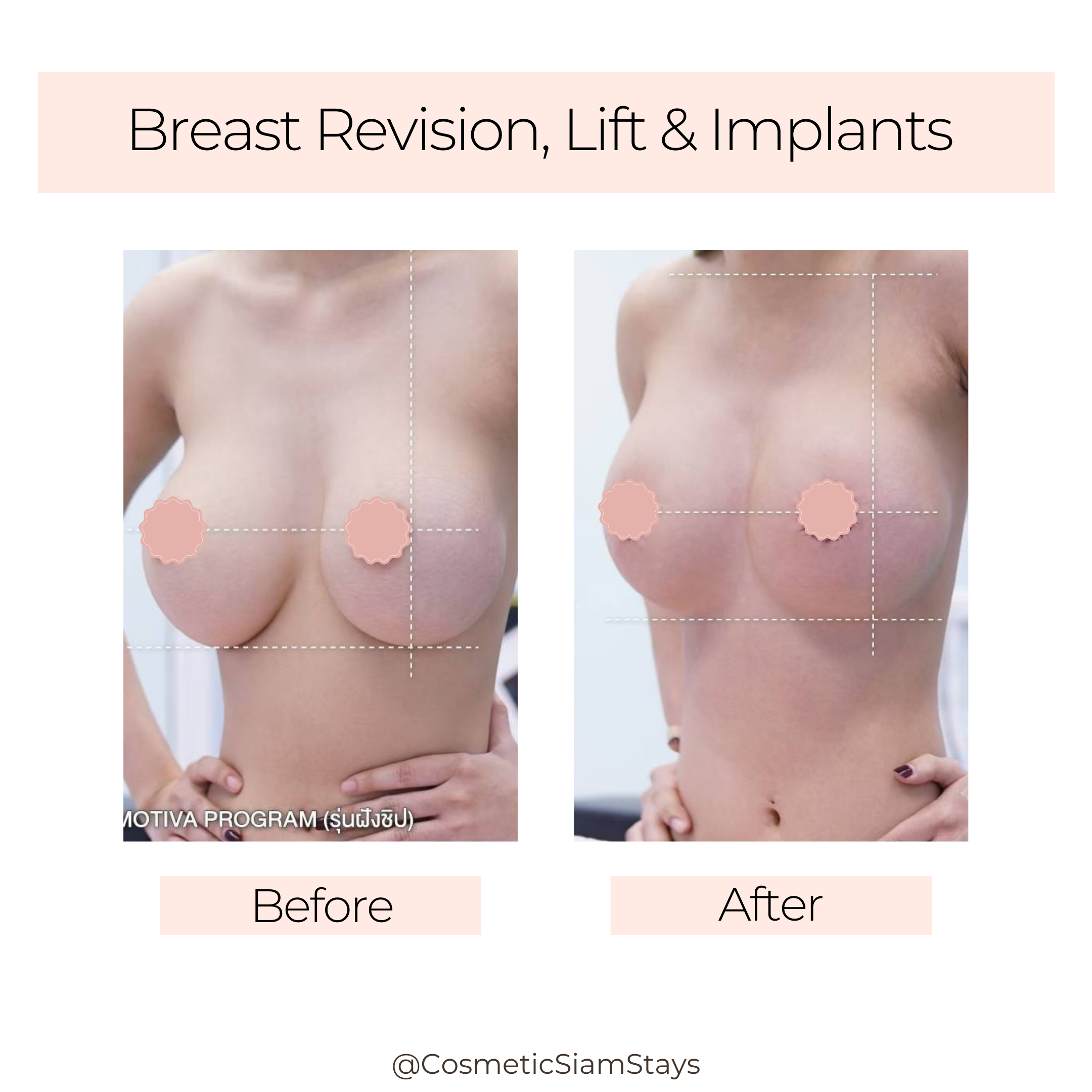 Breast Augmentation 7