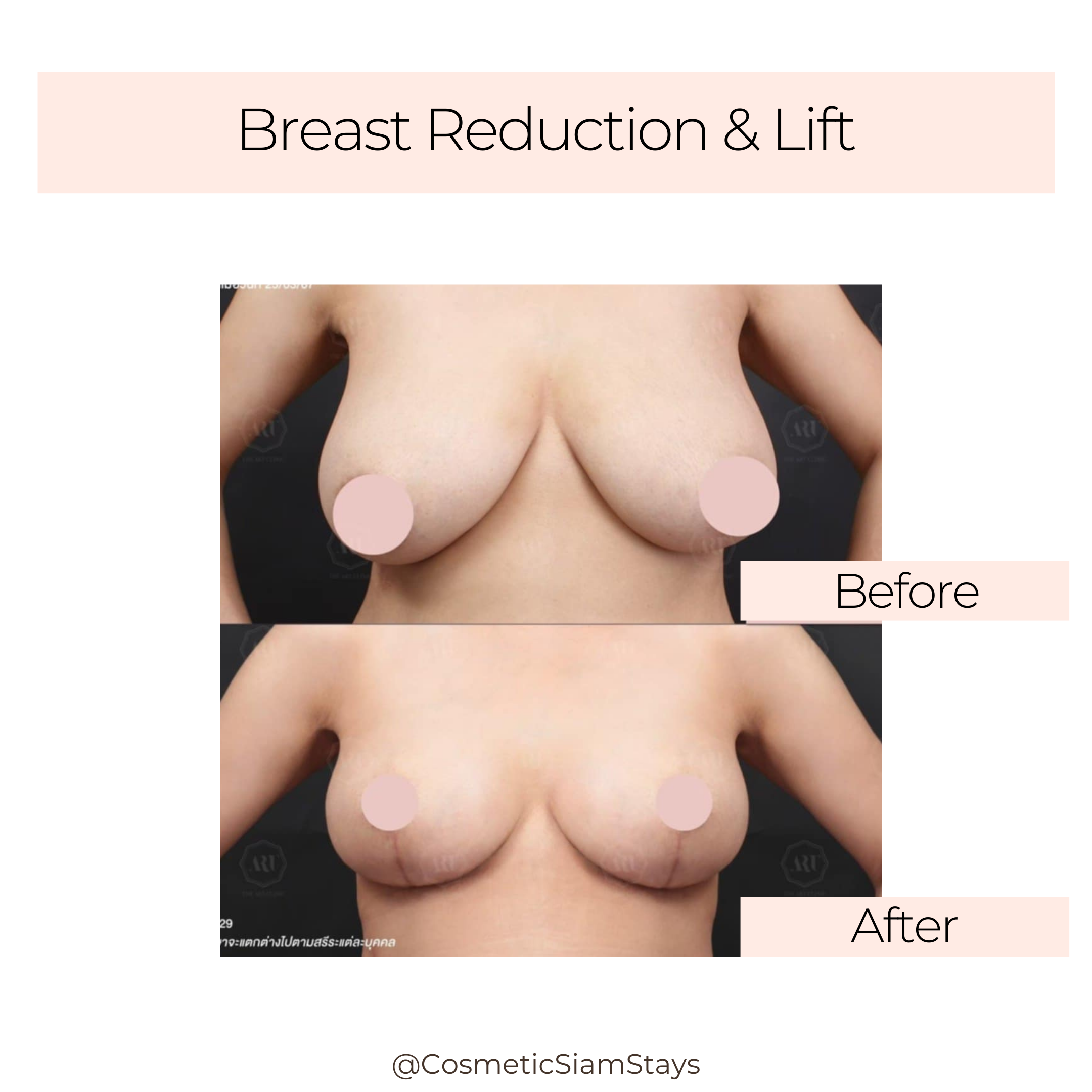 Breast Lift 7