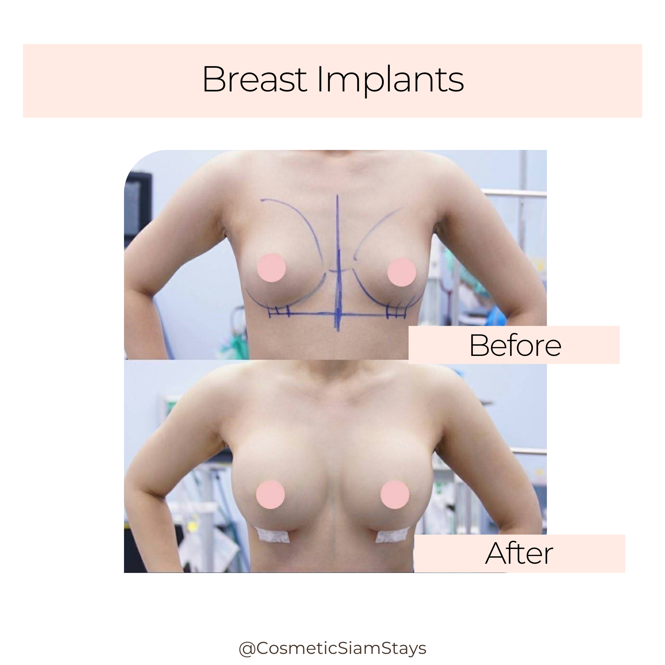Breast Augmentation 2