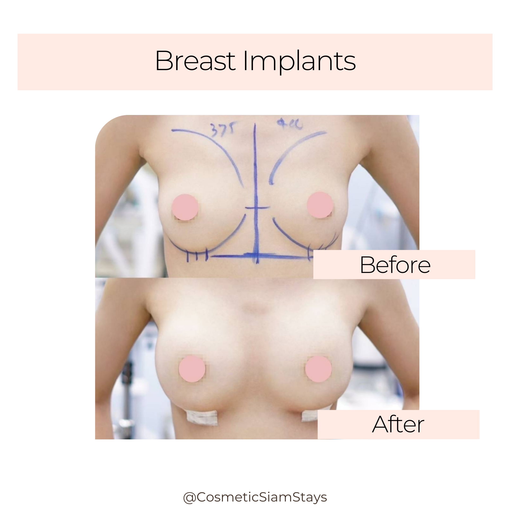 Breast Augmentation 3