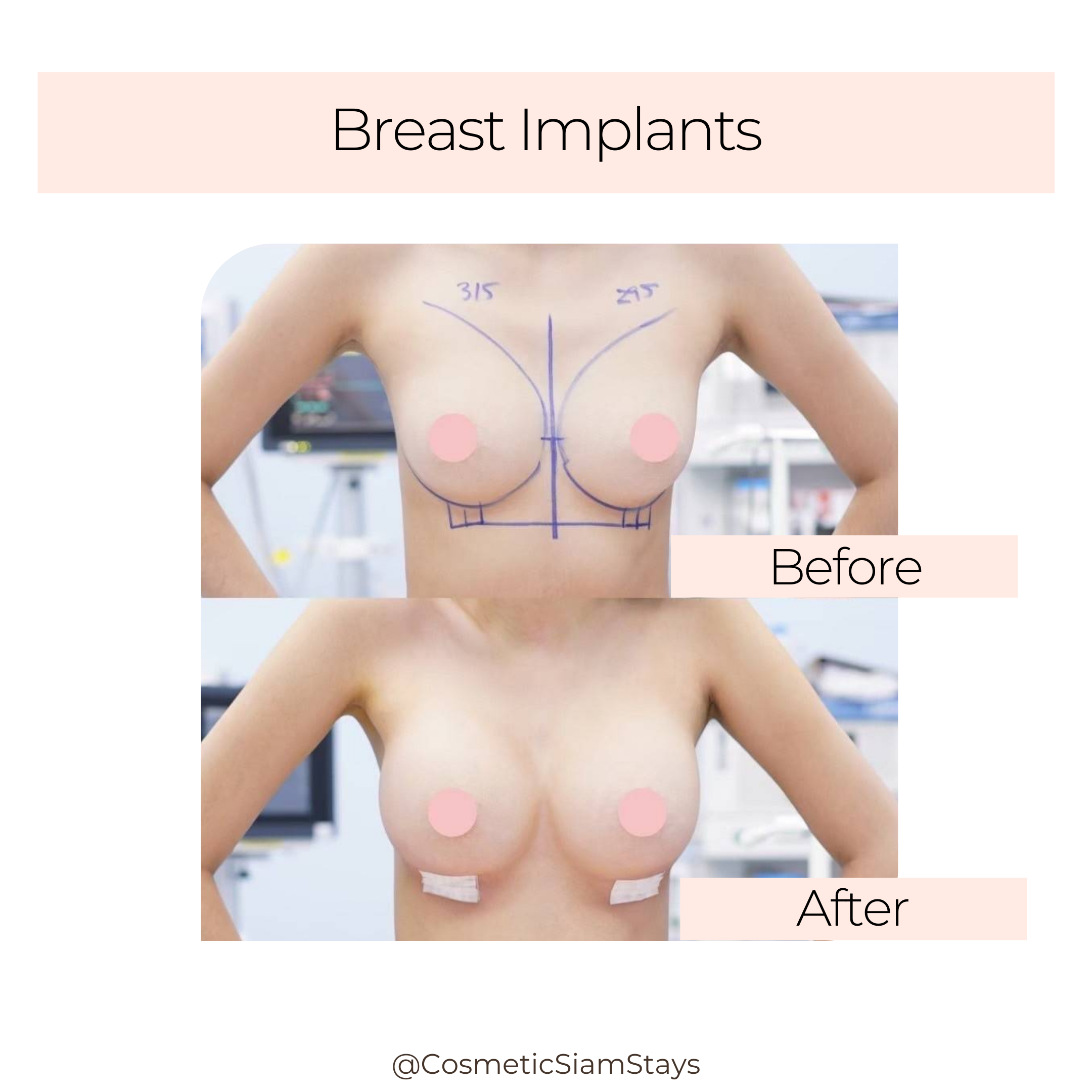 Breast Augmentation 4