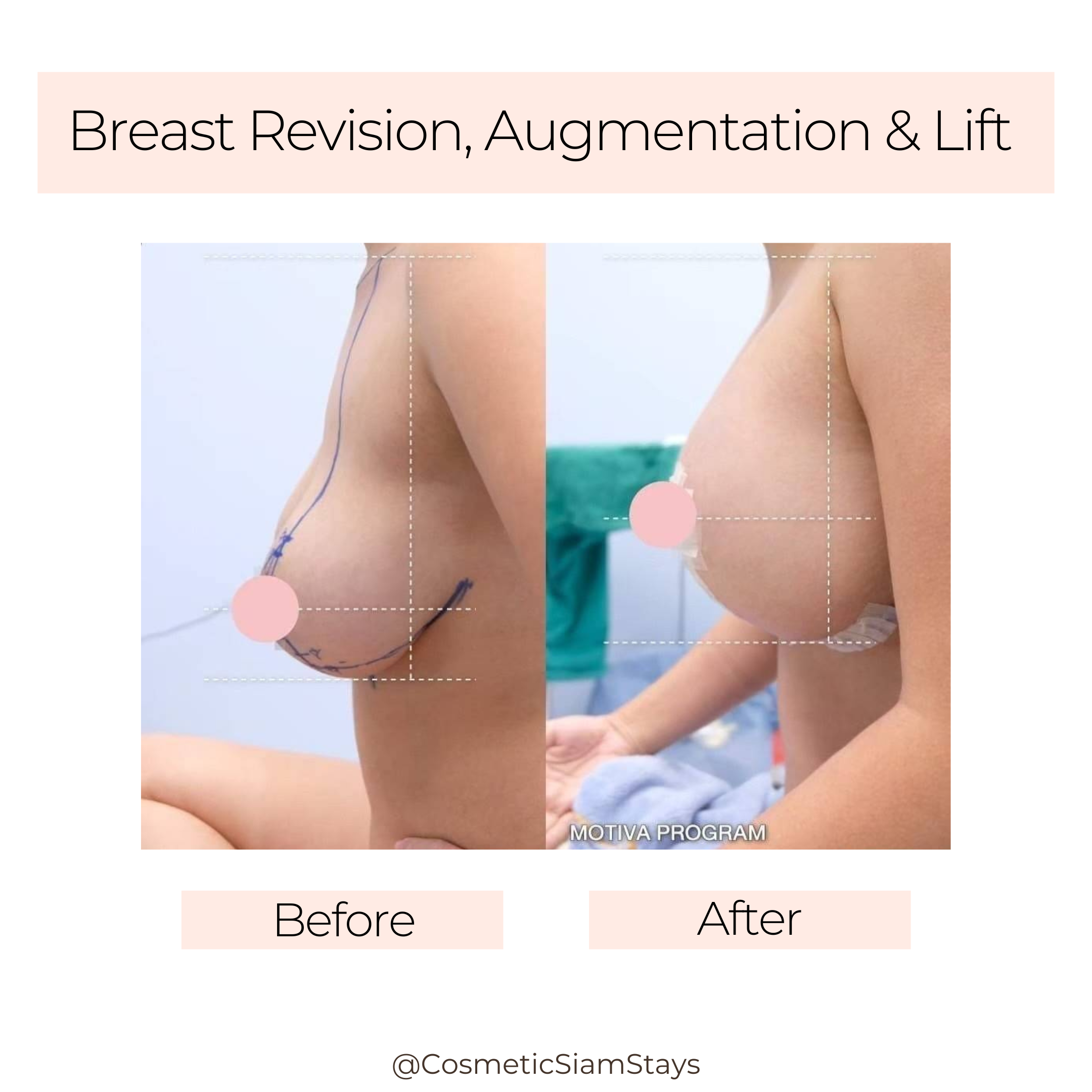 Breast Augmentation 6