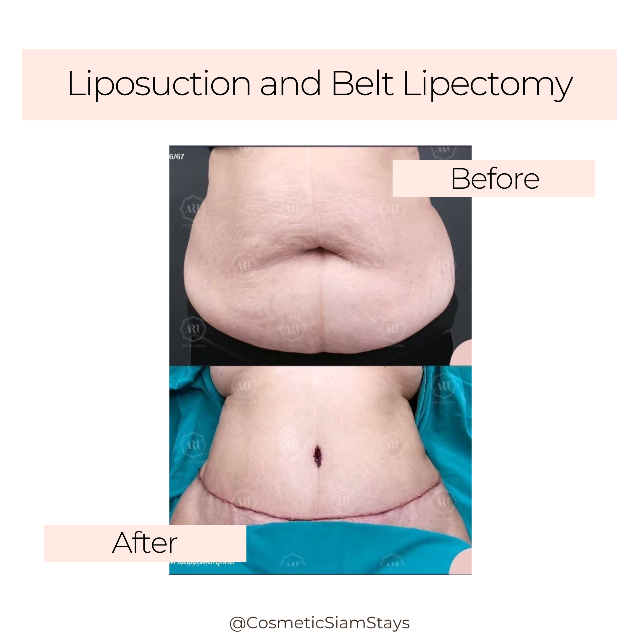 Tummy Tuck 5