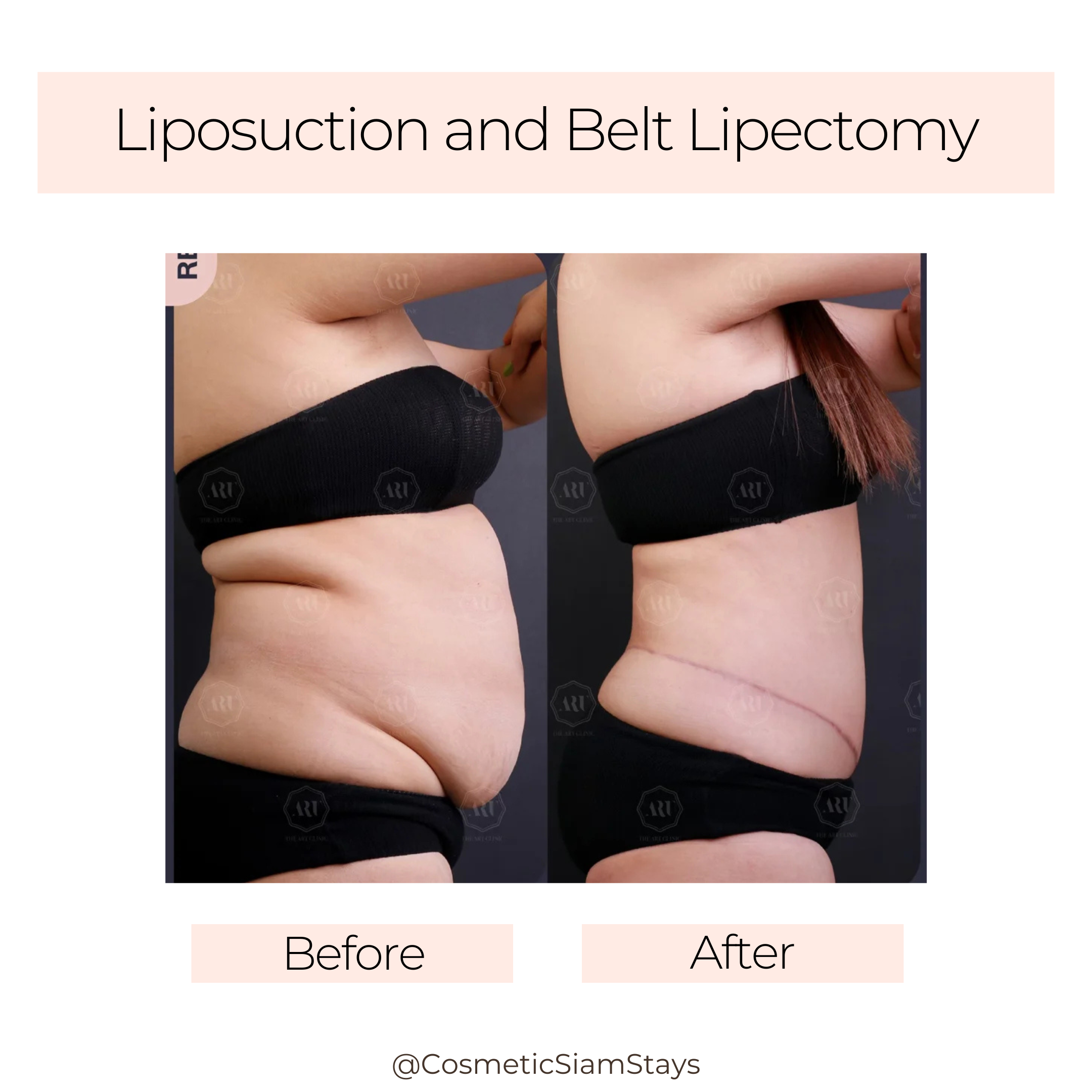 Tummy Tuck 3