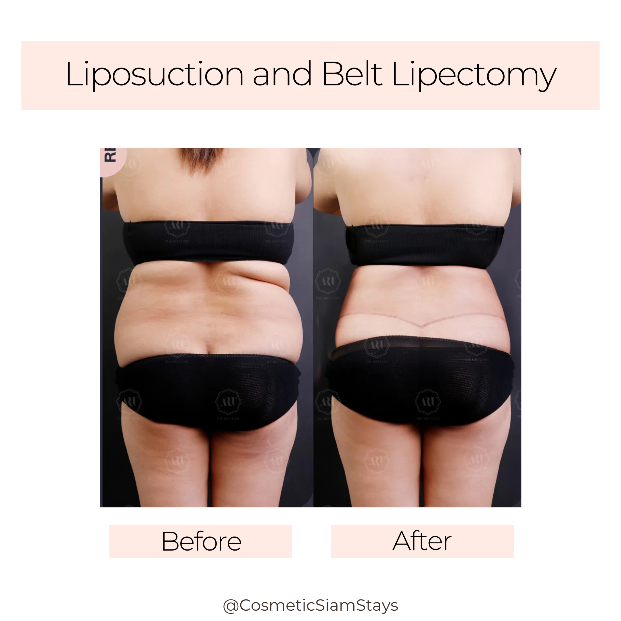 Tummy Tuck 4