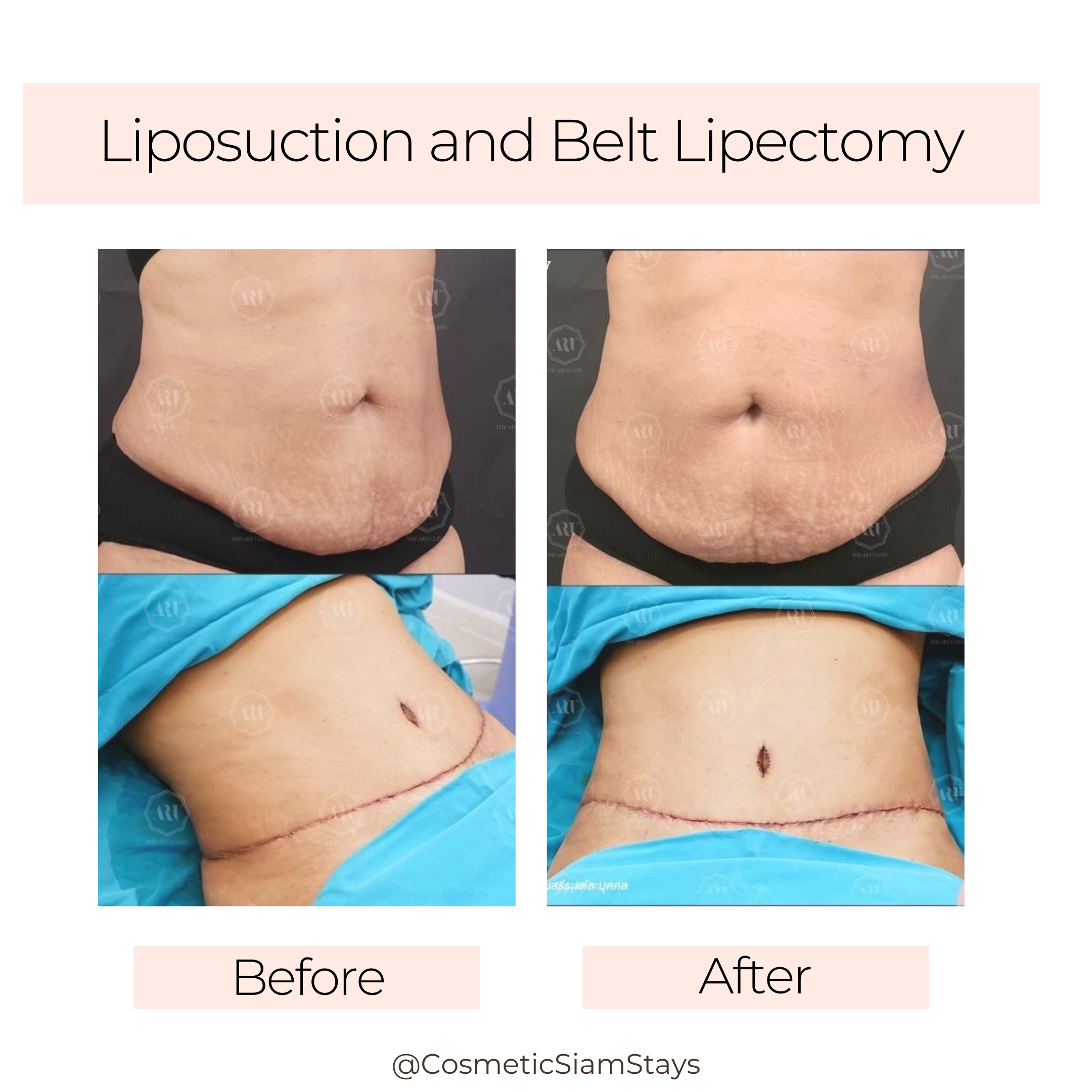 Tummy Tuck 1